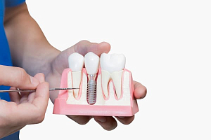 Отторжение зубных имплантов