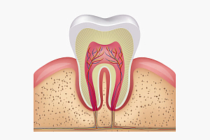 Как убить нерв в зубе?