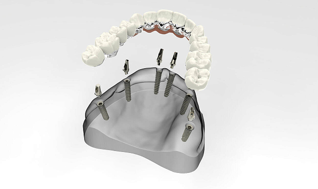 Съемный протез на имплантах