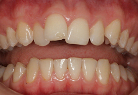 Выравнивание и реставрация зубов