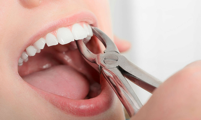 Экстирпация зуба