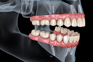 Что лучше: съемный протез или имплант