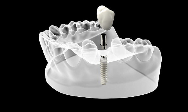 Импланты на жевательные зубы