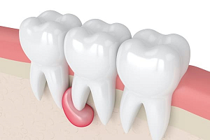 Киста на зубе – лечение или удаление?