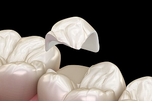 Керамическая вкладка на зуб