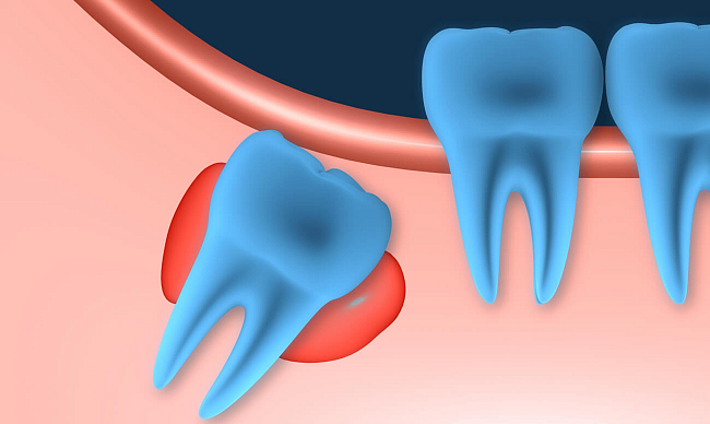 Киста зуба мудрости