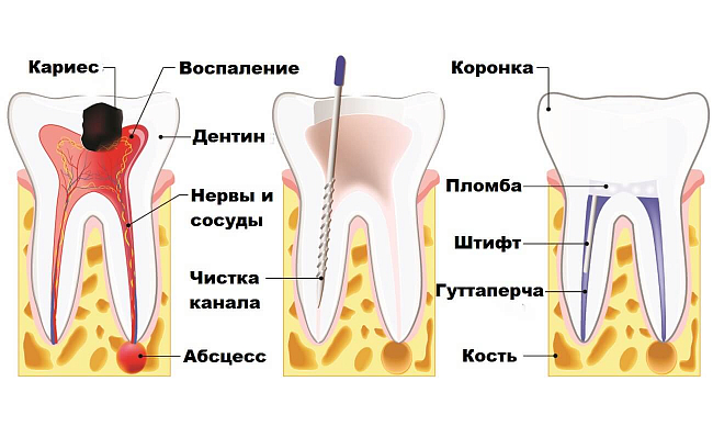 Депульпирование