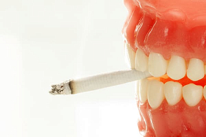 Имплантация зубов и курение — две вещи несовместные?