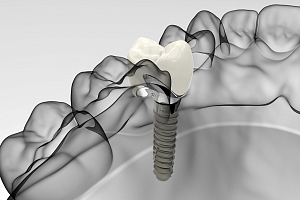 Моментальная имплантация зубов