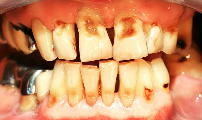 Эрозия эмали зубов — что это такое, причины и симптомы
