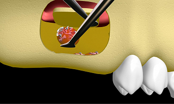 Имплантация зубов после синус-лифтинга