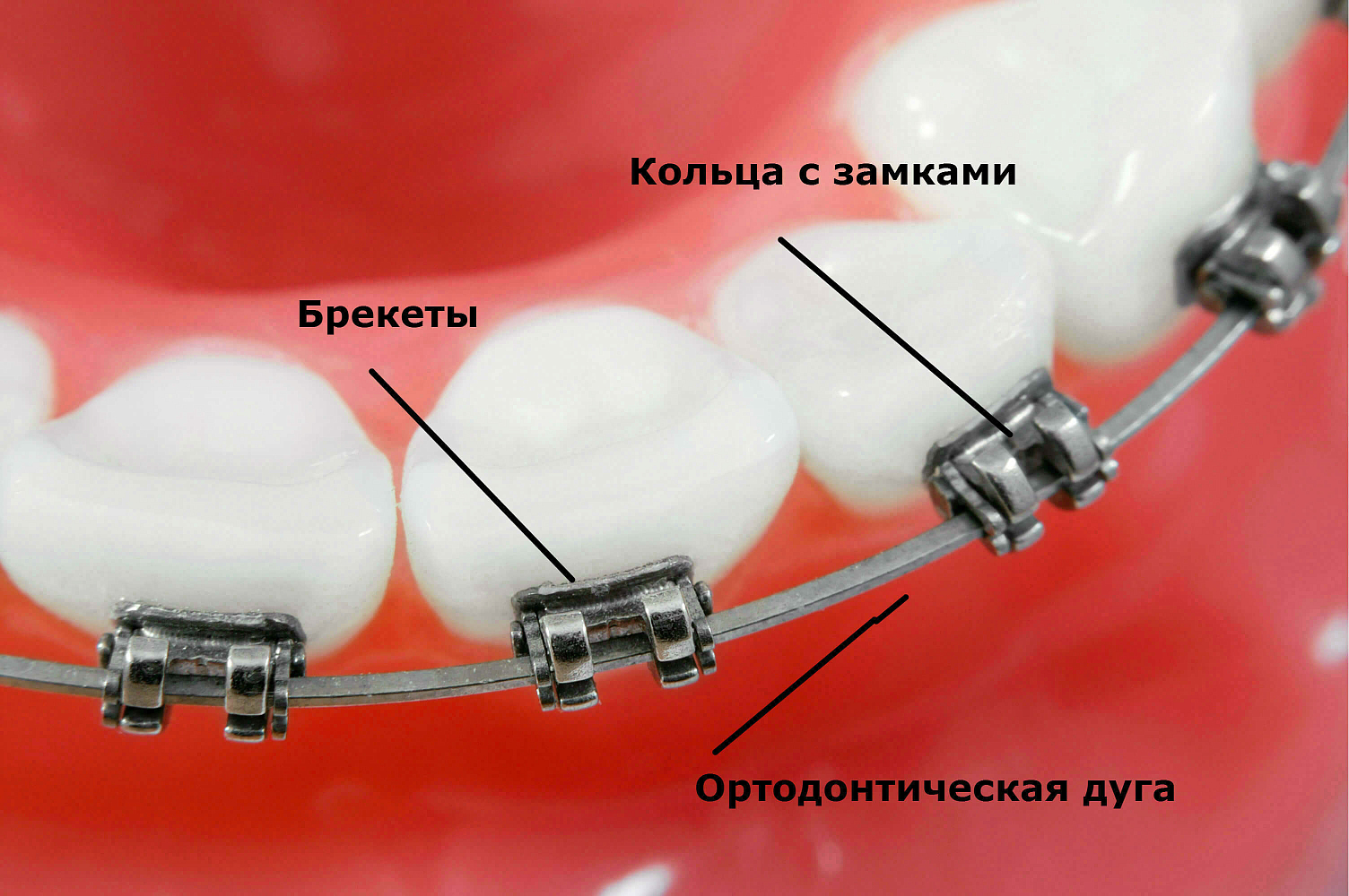 Кольцо ортодонтическое
