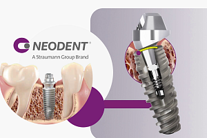 Импланты «Неодент»