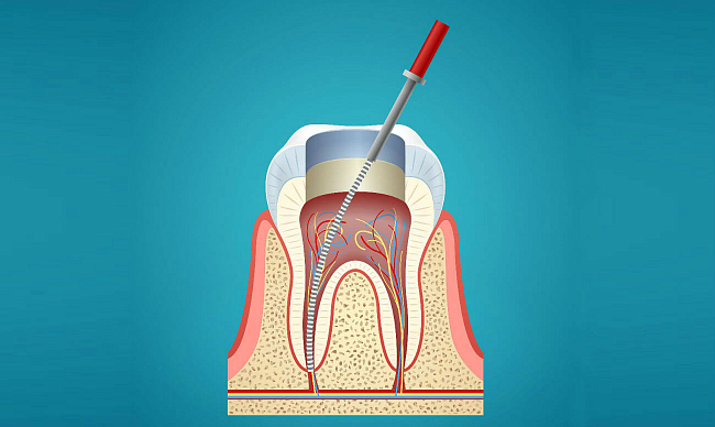Облитерация каналов зуба