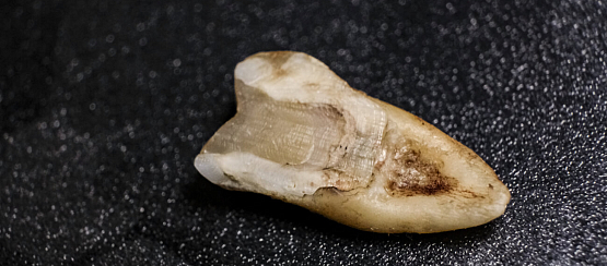 Травма зуба