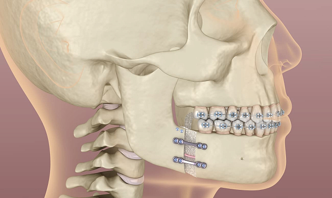 Исправление прикуса хирургическим путем