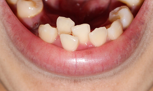 Сонник Кривой зуб: к чему снятся Кривой зуб женщине или мужчине