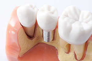 Производители имплантов зубов