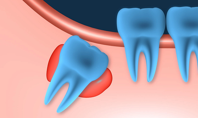 Отсутствие зубов мудрости