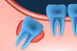Отсутствие зубов мудрости