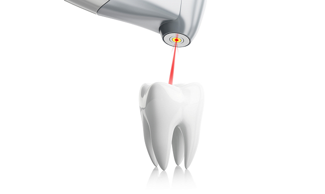 Лечение кисты зуба лазером
