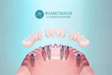 Полное протезирование челюсти на имплантах на трех циркониевых мостах