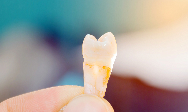 Что такое зуб мудрости – строение и особенности