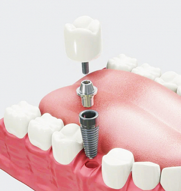 Установка импланта с циркониевой коронкой за 65 тыс. руб.