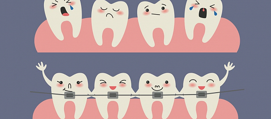 Брекеты для детей