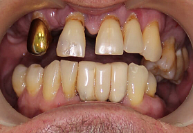 Установка имплантов при полной адентии верхней челюсти и несостоятельности нижних зубов