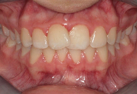 Исправление скученности зубов элайнерами Invisalign®