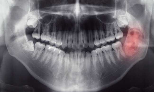 Гранулема зуба — что это такое?